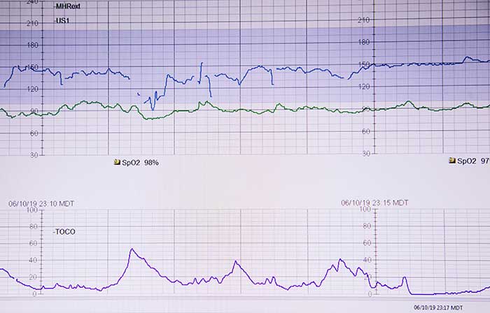 tout savoir sur les contractions de Braxton Hicks