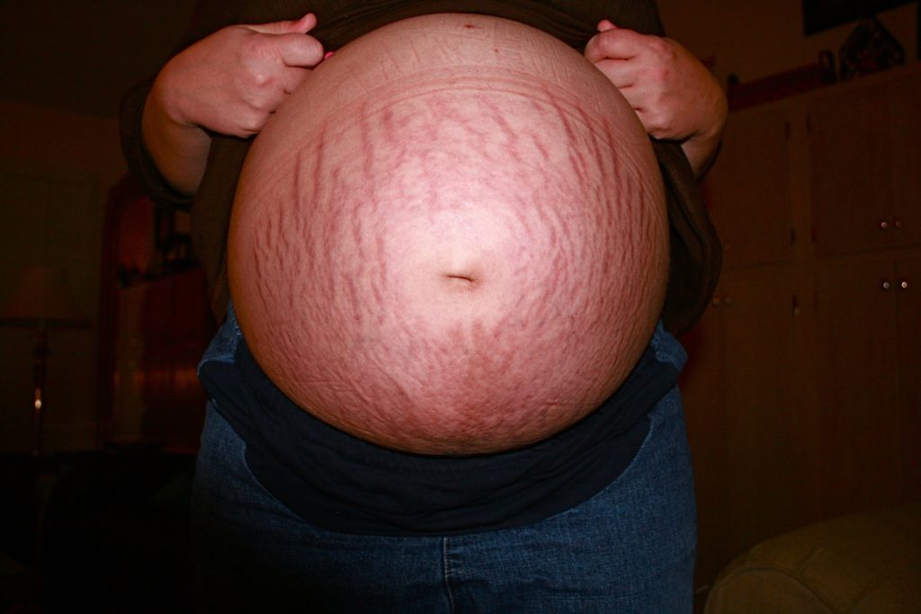 5 mois de grossesse : prévenir les vergetures
